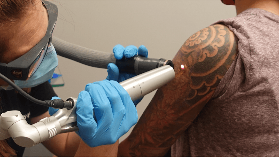 Removery Tattoo Removal & Fading photo 2
